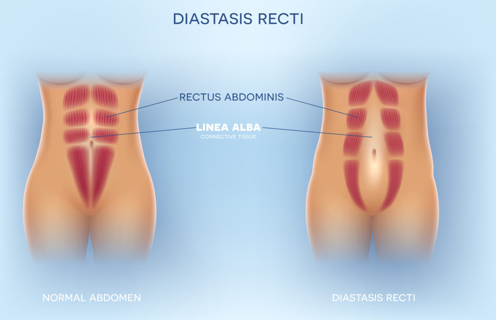 Diastasis Recti also known as Diastasis Rectus Abdominis or abdominal separation, it is common among pregnant women and post birth. There is a gap between the rectus abdominis muscles.