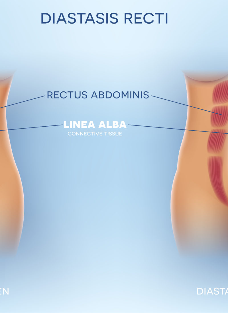 diagram of diastasis recti abdominis